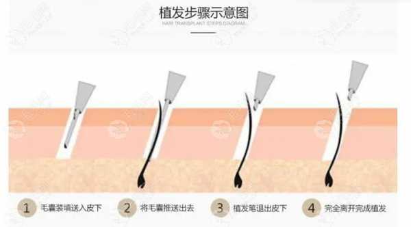 种植毛发机构